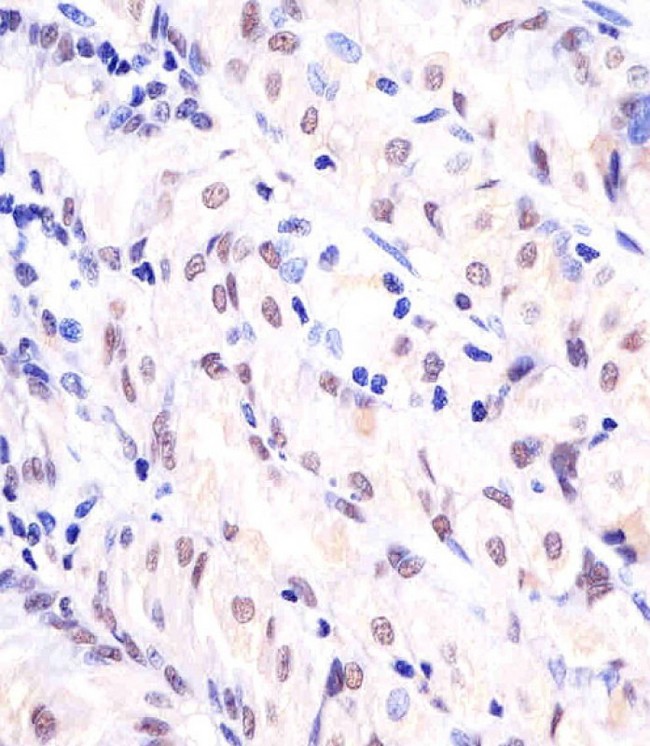 APEX1 / APE1 Antibody - Antibody staining APEX1 in human stomach sections by Immunohistochemistry (IHC-P - paraformaldehyde-fixed, paraffin-embedded sections). Tissue was fixed with formaldehyde and blocked with 3% BSA for 0. 5 hour at room temperature; antigen retrieval was by heat mediation with a citrate buffer (pH 6). Samples were incubated with primary antibody (1:25) for 1 hours at 37°C. A undiluted biotinylated goat polyvalent antibody was used as the secondary antibody.