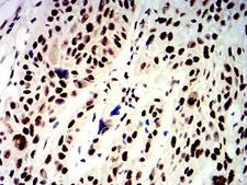 APEX1 / APE1 Antibody - Immunohistochemical analysis of paraffin-embedded esophageal cancer tissues using APEX1 mouse mAb with DAB staining.