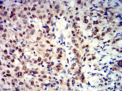 APEX1 / APE1 Antibody - Immunohistochemical analysis of paraffin-embedded breast cancer tissues using APEX1 mouse mAb with DAB staining.
