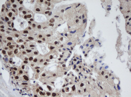 APEX1 / APE1 Antibody - IHC of paraffin-embedded Adenocarcinoma of Human breast tissue using anti-APEX1 mouse monoclonal antibody.