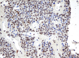 APEX1 / APE1 Antibody - IHC of paraffin-embedded Carcinoma of Human pancreas tissue using anti-APEX1 mouse monoclonal antibody.