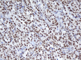 APEX1 / APE1 Antibody - IHC of paraffin-embedded Carcinoma of Human thyroid tissue using anti-APEX1 mouse monoclonal antibody.