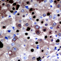 APEX1 / APE1 Antibody - Immunohistochemical analysis of APE1 staining in human liver cancer formalin fixed paraffin embedded tissue section. The section was pre-treated using heat mediated antigen retrieval with sodium citrate buffer (pH 6.0). The section was then incubated with the antibody at room temperature and detected using an HRP conjugated compact polymer system. DAB was used as the chromogen. The section was then counterstained with hematoxylin and mounted with DPX.