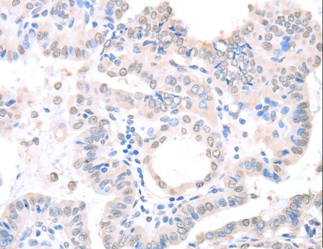 APEX1 / APE1 Antibody - Immunohistochemistry of paraffin-embedded Human thyroid cancer using APEX1 Polyclonal Antibody at dilution of 1:20.