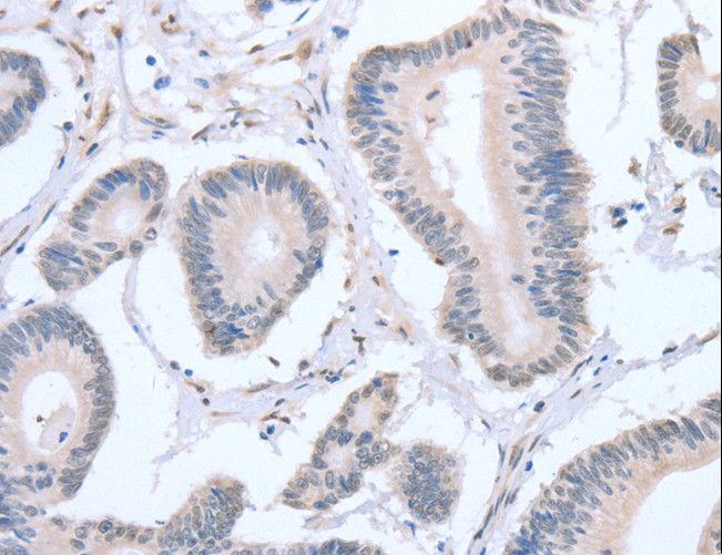 APEX1 / APE1 Antibody - Immunohistochemistry of paraffin-embedded Human colon cancer using APEX1 Polyclonal Antibody at dilution of 1:20.