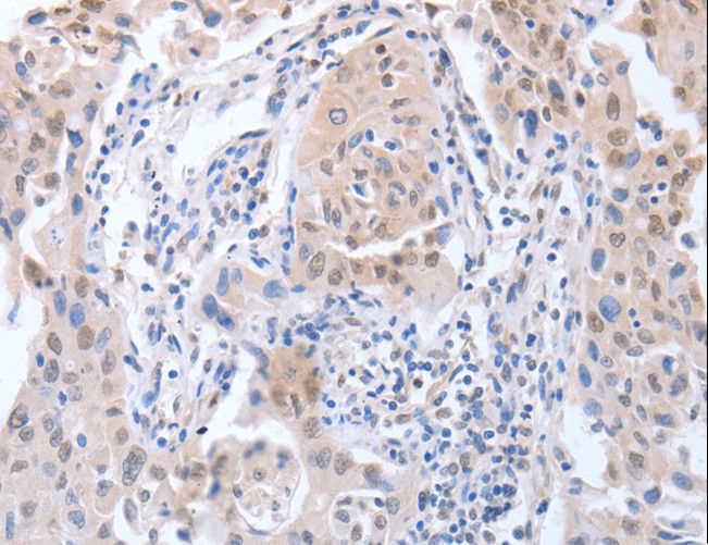 APEX1 / APE1 Antibody - Immunohistochemistry of paraffin-embedded Human lung cancer using APEX1 Polyclonal Antibody at dilution of 1:20.
