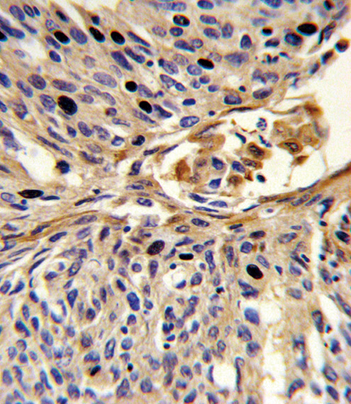 APEX2 Antibody - Formalin-fixed and paraffin-embedded human lung carcinoma reacted with APEX2 Antibody , which was peroxidase-conjugated to the secondary antibody, followed by DAB staining. This data demonstrates the use of this antibody for immunohistochemistry; clinical relevance has not been evaluated.