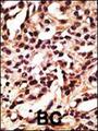 APG12 / ATG12 Antibody - Formalin-fixed and paraffin-embedded human cancer tissue reacted with the primary antibody, which was peroxidase-conjugated to the secondary antibody, followed by DAB staining. This data demonstrates the use of this antibody for immunohistochemistry; clinical relevance has not been evaluated. BC = breast carcinoma; HC = hepatocarcinoma.