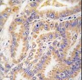 APG12 / ATG12 Antibody - Formalin-fixed and paraffin-embedded human lung carcinoma tissue reacted with Autophagy APG12L antibody , which was peroxidase-conjugated to the secondary antibody, followed by DAB staining. This data demonstrates the use of this antibody for immunohistochemistry; clinical relevance has not been evaluated.