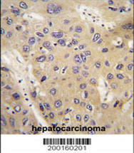 APG12 / ATG12 Antibody - Formalin-fixed and paraffin-embedded human hepatocarcinoma tissue and lung carcinoma tissue reacted with APG12L Monoclonal Antibody , which was peroxidase-conjugated to the secondary antibody, followed by DAB staining. This data demonstrates the use of this antibody for immunohistochemistry; clinical relevance has not been evaluated.