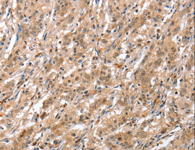 APG12 / ATG12 Antibody - Immunohistochemistry of paraffin-embedded Human gastric cancer using ATG12 Polyclonal Antibody at dilution of 1:70.