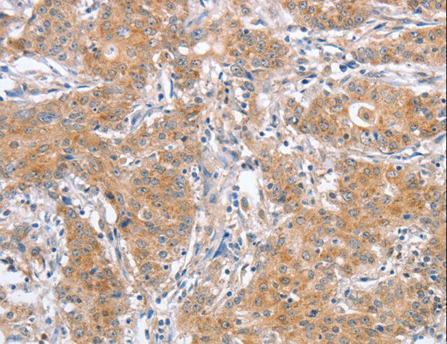 APG12 / ATG12 Antibody - Immunohistochemistry of paraffin-embedded Human liver cancer using ATG12 Polyclonal Antibody at dilution of 1:40.