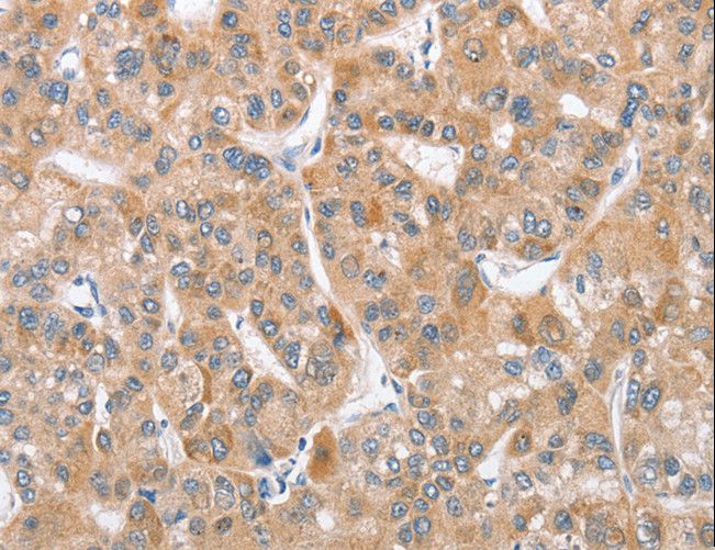 APG12 / ATG12 Antibody - Immunohistochemistry of paraffin-embedded Human liver cancer using ATG12 Polyclonal Antibody at dilution of 1:40.