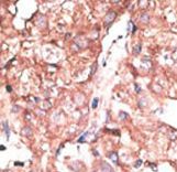 APG4B / ATG4B Antibody - Formalin-fixed and paraffin-embedded human cancer tissue reacted with the primary antibody, which was peroxidase-conjugated to the secondary antibody, followed by DAB staining. This data demonstrates the use of this antibody for immunohistochemistry; clinical relevance has not been evaluated. BC = breast carcinoma; HC = hepatocarcinoma.