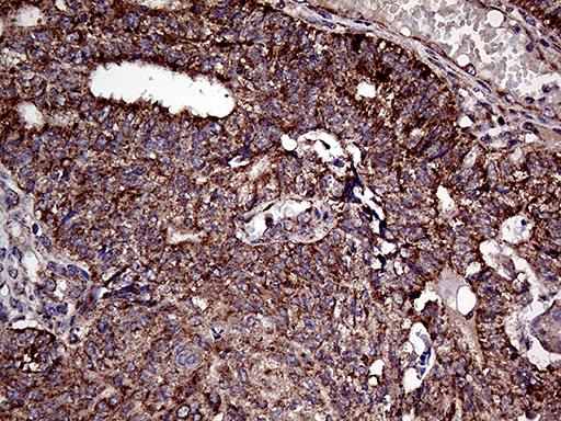 APG4B / ATG4B Antibody - Immunohistochemical staining of paraffin-embedded Adenocarcinoma of Human endometrium tissue using anti-ATG4B mouse monoclonal antibody. (Heat-induced epitope retrieval by 1mM EDTA in 10mM Tris buffer. (pH8.5) at 120°C for 3 min. (1:2000)