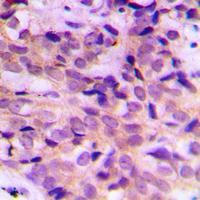 APG4B / ATG4B Antibody - Immunohistochemical analysis of ATG4B staining in human breast cancer formalin fixed paraffin embedded tissue section. The section was pre-treated using heat mediated antigen retrieval with sodium citrate buffer (pH 6.0). The section was then incubated with the antibody at room temperature and detected using an HRP conjugated compact polymer system. DAB was used as the chromogen. The section was then counterstained with hematoxylin and mounted with DPX. w