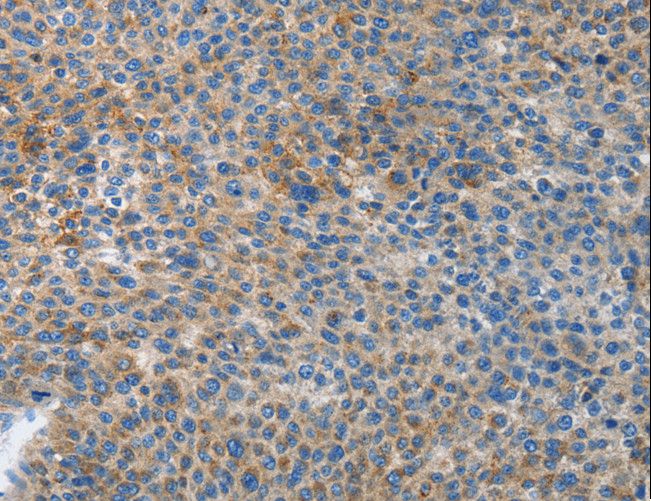 APG4B / ATG4B Antibody - Immunohistochemistry of paraffin-embedded Human liver cancer using ATG4B Polyclonal Antibody at dilution of 1:50.
