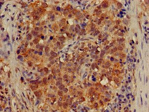 APG4B / ATG4B Antibody - Immunohistochemistry of paraffin-embedded human pancreatic cancer using ATG4B Antibody at dilution of 1:100