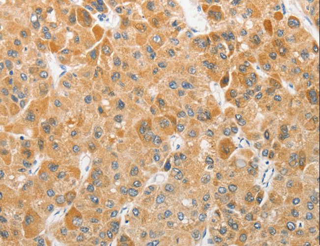 APG5 / ATG5 Antibody - Immunohistochemistry of paraffin-embedded Human liver cancer using ATG5 Polyclonal Antibody at dilution of 1:40.