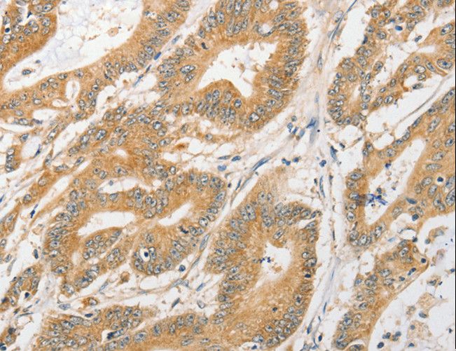 APG5 / ATG5 Antibody - Immunohistochemistry of paraffin-embedded Human lung cancer using ATG5 Polyclonal Antibody at dilution of 1:40.