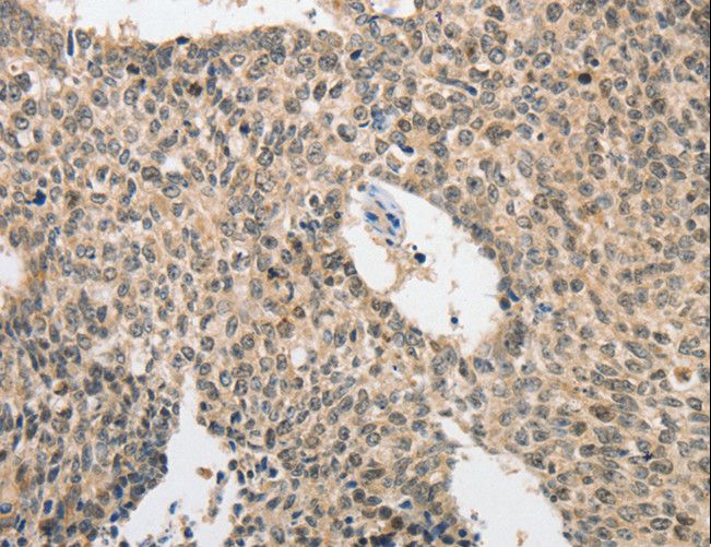 APG5 / ATG5 Antibody - Immunohistochemistry of paraffin-embedded Human lung cancer using ATG5 Polyclonal Antibody at dilution of 1:40.