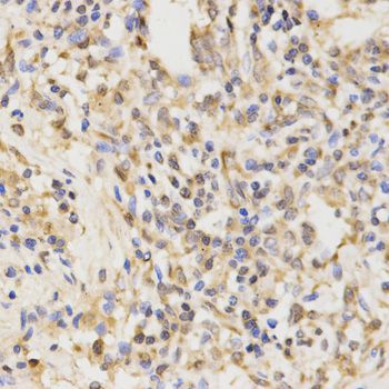 APG5 / ATG5 Antibody - Immunohistochemistry of paraffin-embedded human lung cancer using ATG5 antibody at dilution of 1:100 (40x lens).