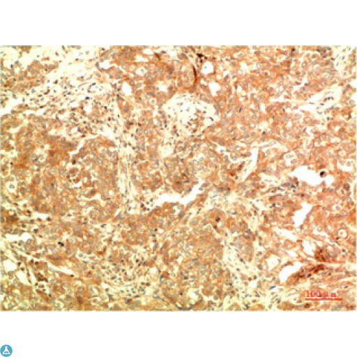 APG5 / ATG5 Antibody - Immunohistochemical analysis of paraffin-embedded Human Ovarian Carcinoma Tissue using ATG5 Mouse monoclonal antibody diluted at 1:200.