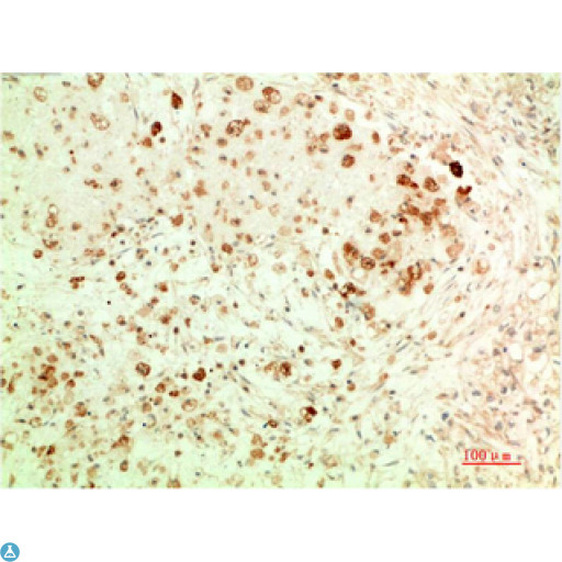 APG5 / ATG5 Antibody - Immunohistochemical analysis of paraffin-embedded Human Breast Carcinoma Tissue using ATG5 Mouse monoclonal antibody diluted at 1:200.