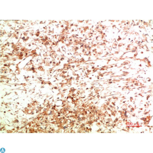 APG5 / ATG5 Antibody - Immunohistochemical analysis of paraffin-embedded Human Ovarian Carcinoma Tissue using ATG5 Mouse mAb diluted at 1:200.