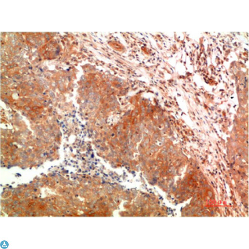 APG5 / ATG5 Antibody - Immunohistochemical analysis of paraffin-embedded Human Breast Carcinoma Tissue using ATG5 Mouse mAb diluted at 1:200.