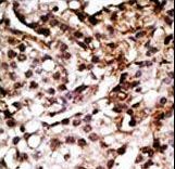 Apg7 / ATG7 Antibody - Formalin-fixed and paraffin-embedded human cancer tissue reacted with the primary antibody, which was peroxidase-conjugated to the secondary antibody, followed by AEC staining. This data demonstrates the use of this antibody for immunohistochemistry; clinical relevance has not been evaluated. BC = breast carcinoma; HC = hepatocarcinoma.