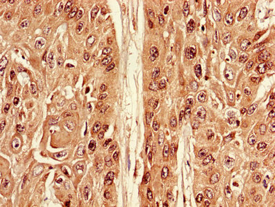 Apg7 / ATG7 Antibody - Immunohistochemistry of paraffin-embedded human cervical cancer using ATG7 Antibody at dilution of 1:100