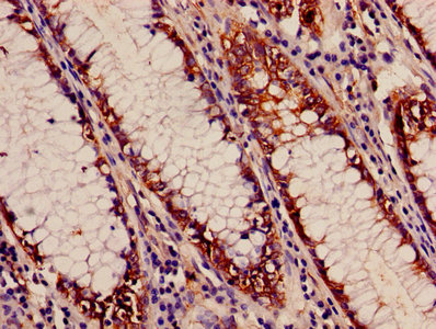 APH / APEH Antibody - Immunohistochemistry of paraffin-embedded human colon cancer using APEH Antibody at dilution of 1:100