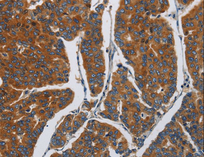 APH / APEH Antibody - Immunohistochemistry of paraffin-embedded Human breast cancer using APEH Polyclonal Antibody at dilution of 1:30.