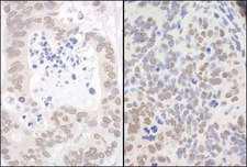 API5 Antibody - Detection of Human and Mouse API5 by Immunohistochemistry. Sample: FFPE section of human breast carcinoma (left) and mouse teratoma (right). Antibody: Affinity purified rabbit anti-API5 used at a dilution of 1:1000 (0.2 ug/mg) and 1:200 (1 ug/mg).