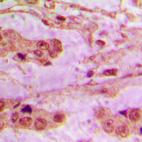 API5 Antibody - Immunohistochemical analysis of API5 staining in human lung cancer formalin fixed paraffin embedded tissue section. The section was pre-treated using heat mediated antigen retrieval with sodium citrate buffer (pH 6.0). The section was then incubated with the antibody at room temperature and detected using an HRP conjugated compact polymer system. DAB was used as the chromogen. The section was then counterstained with hematoxylin and mounted with DPX.