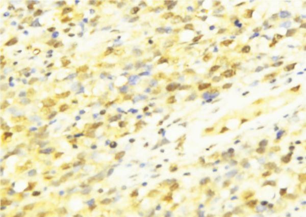 APITD1 Antibody - 1:100 staining human breast carcinoma tissue by IHC-P. The sample was formaldehyde fixed and a heat mediated antigen retrieval step in citrate buffer was performed. The sample was then blocked and incubated with the antibody for 1.5 hours at 22°C. An HRP conjugated goat anti-rabbit antibody was used as the secondary.