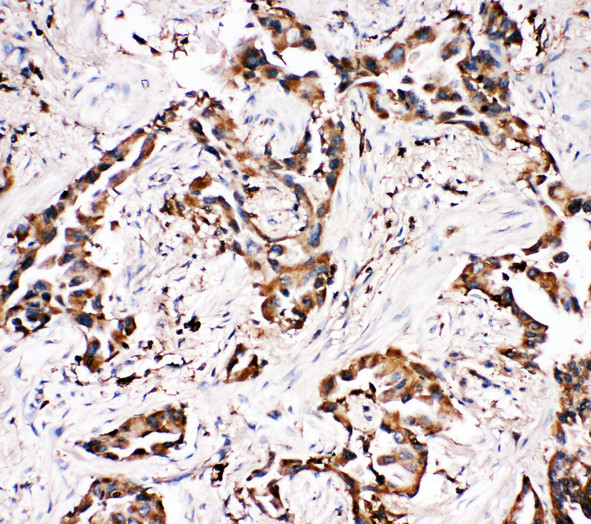 APLP1 / APLP-1 Antibody - APLP1 / APLP-1 antibody. IHC(P): Human Lung Cancer Tissue.