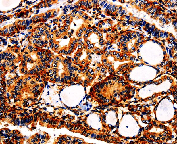 APLP1 / APLP-1 Antibody - Immunohistochemistry of paraffin-embedded Human thyroid cancer using APLP1 Polyclonal Antibody at dilution of 1:25.