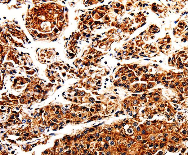 APLP1 / APLP-1 Antibody - Immunohistochemistry of paraffin-embedded Human liver cancer using APLP1 Polyclonal Antibody at dilution of 1:25.
