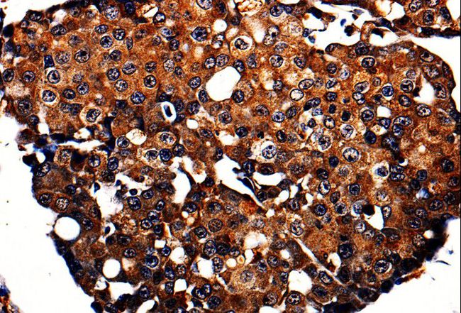 APLP1 / APLP-1 Antibody - Immunohistochemistry of paraffin-embedded Human breast cancer using APLP1 Polyclonal Antibody at dilution of 1:10.