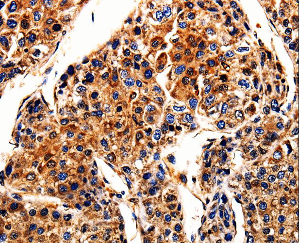 APLP1 / APLP-1 Antibody - Immunohistochemistry of paraffin-embedded Human liver cancer using APLP1 Polyclonal Antibody at dilution of 1:10.