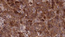 APLP1 / APLP-1 Antibody - 1:100 staining human liver carcinoma tissues by IHC-P. The sample was formaldehyde fixed and a heat mediated antigen retrieval step in citrate buffer was performed. The sample was then blocked and incubated with the antibody for 1.5 hours at 22°C. An HRP conjugated goat anti-rabbit antibody was used as the secondary.