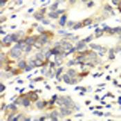 APLP1 / APLP-1 Antibody - Immunohistochemistry of paraffin-embedded Human colon carcinoma using APLP1 Polyclonal Antibody at dilution of 1:100 (40x lens).