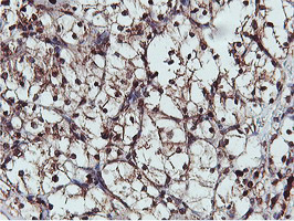 APMAP / C20orf3 Antibody - IHC of paraffin-embedded Carcinoma of Human kidney tissue using anti-C20orf3 mouse monoclonal antibody.