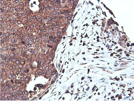 APMAP / C20orf3 Antibody - IHC of paraffin-embedded Carcinoma of Human lung tissue using anti-C20orf3 mouse monoclonal antibody.
