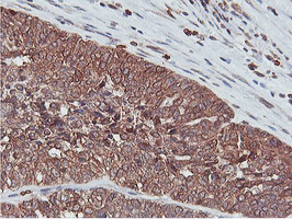 APMAP / C20orf3 Antibody - IHC of paraffin-embedded Adenocarcinoma of Human ovary tissue using anti-C20orf3 mouse monoclonal antibody.