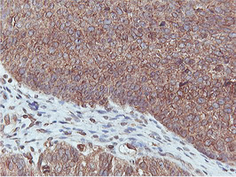 APMAP / C20orf3 Antibody - IHC of paraffin-embedded Carcinoma of Human bladder tissue using anti-C20orf3 mouse monoclonal antibody.
