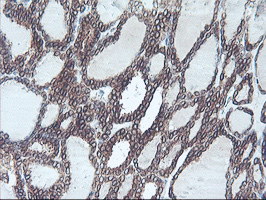 APMAP / C20orf3 Antibody - IHC of paraffin-embedded Carcinoma of Human thyroid tissue using anti-C20orf3 mouse monoclonal antibody. (Heat-induced epitope retrieval by 10mM citric buffer, pH6.0, 100C for 10min).