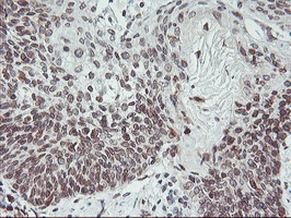 APMAP / C20orf3 Antibody - IHC of paraffin-embedded Carcinoma of Human bladder tissue using anti-C20orf3 mouse monoclonal antibody. (Heat-induced epitope retrieval by 10mM citric buffer, pH6.0, 100C for 10min).